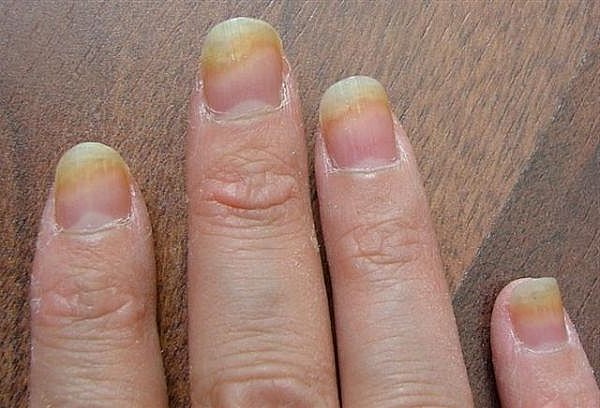 Top các bệnh về móng tay phổ biến nhất – Xu Hướng Nail Zone